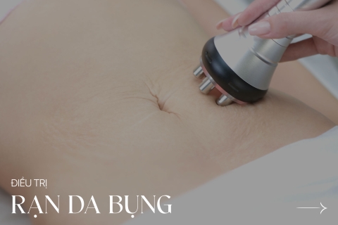 Điều trị rạn da bụng